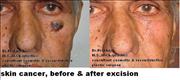 Before After Pictures,Delhi,skin cancer  bcc 